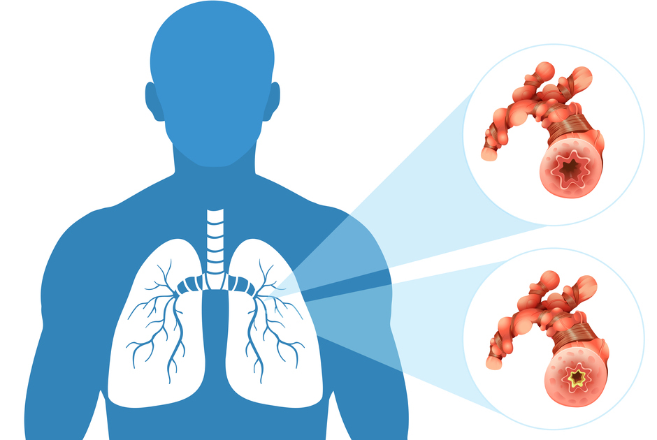 Figura representando a obstrução dos alvéolos causada pela síndrome respiratória aguda grave.